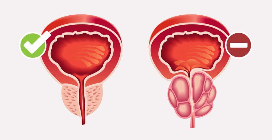 Weiprost normalizza le dimensioni e la funzione della prostata