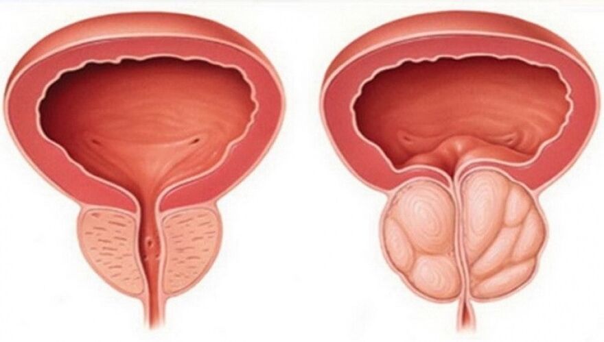 prostata sana e infiammata con prostatite