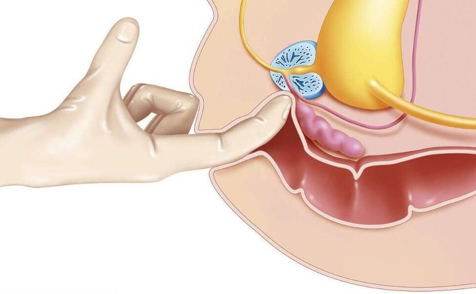 Massaggio prostatico per il trattamento della prostatite