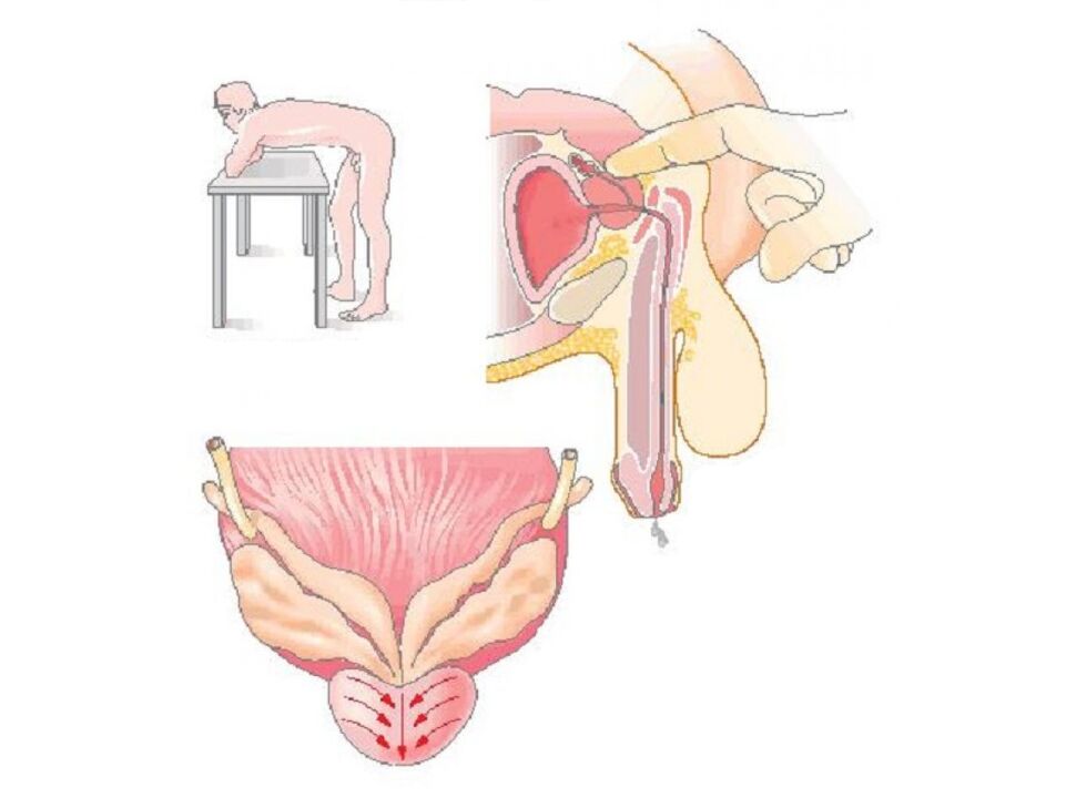 Tecnica di massaggio prostatico da parte di un medico per analizzare la secrezione